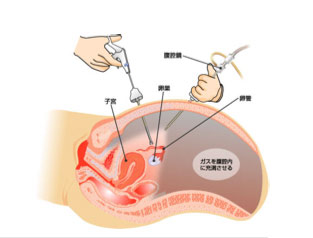 腹腔鏡下手術